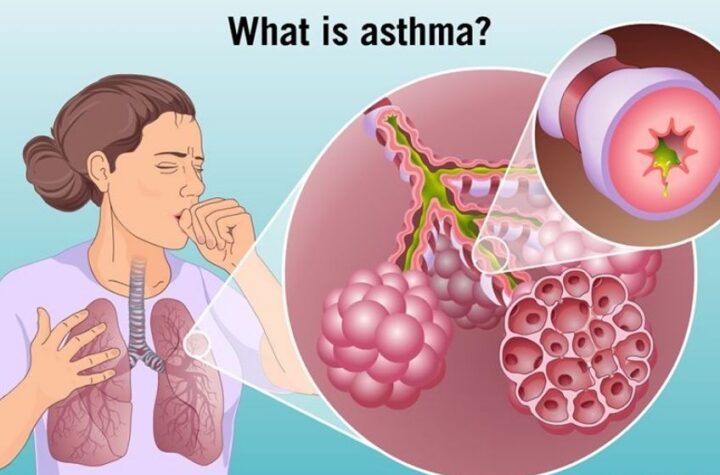 Facts About Asthma And How It Affects Your Mind