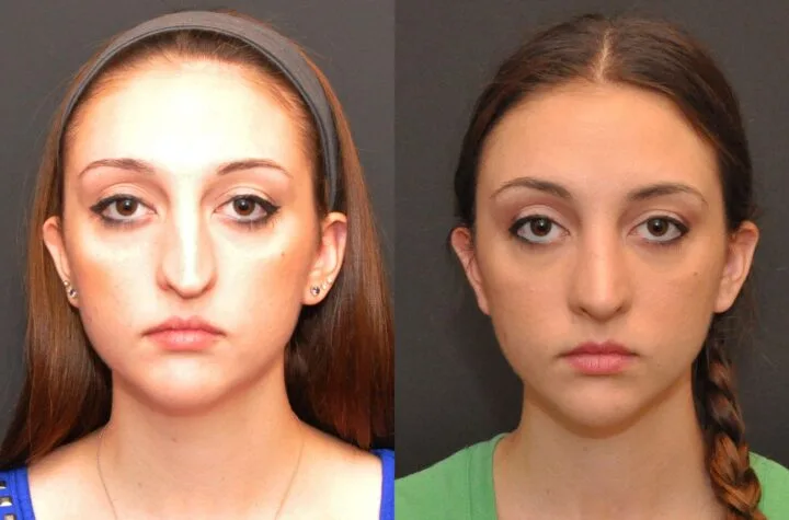 Rhinoplasty in Cincinnati