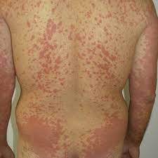 When does a skin cancer rash appear?