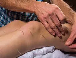 Dry Needling